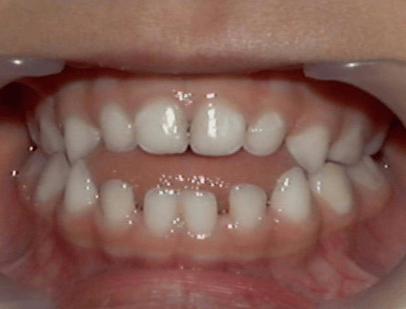 Result of Bad Oral Posture in Humans