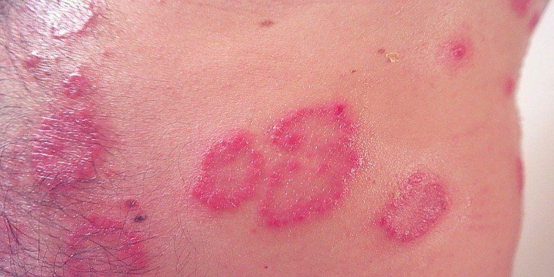 What Eczema Looks Like