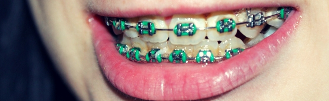 Teen with braces